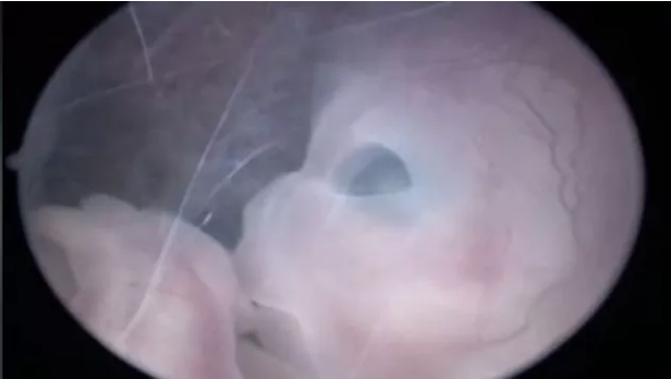 Vídeo de um feto de 10 semanas dentro do útero viraliza